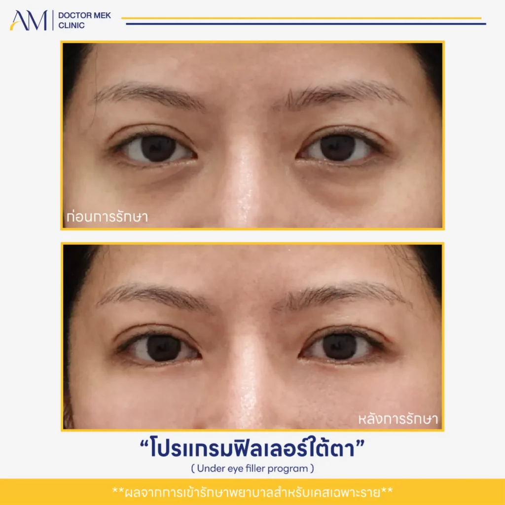 Before-After ฟิลเลอร์ใต้ตา-01