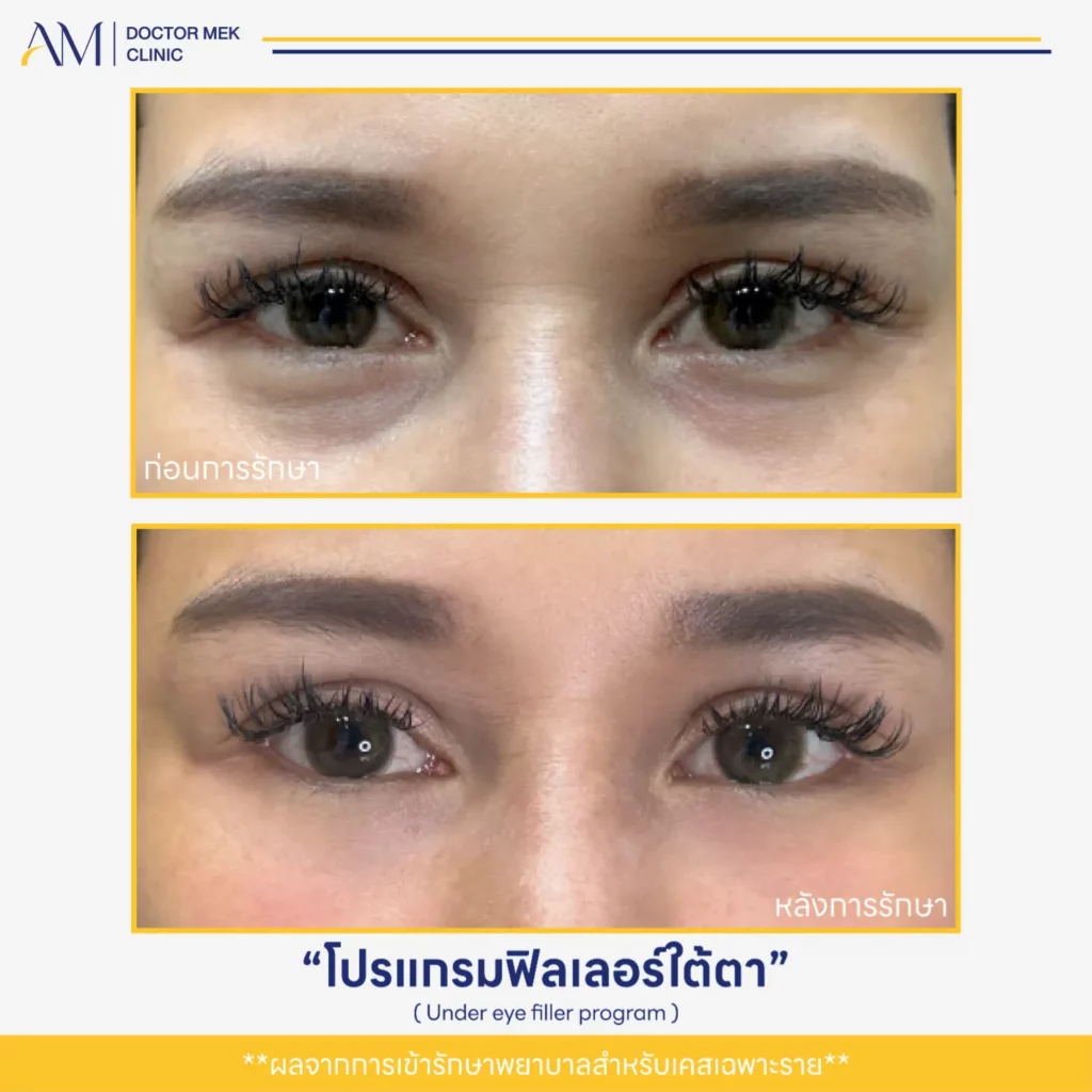 Before-After ฟิลเลอร์ใต้ตา-02