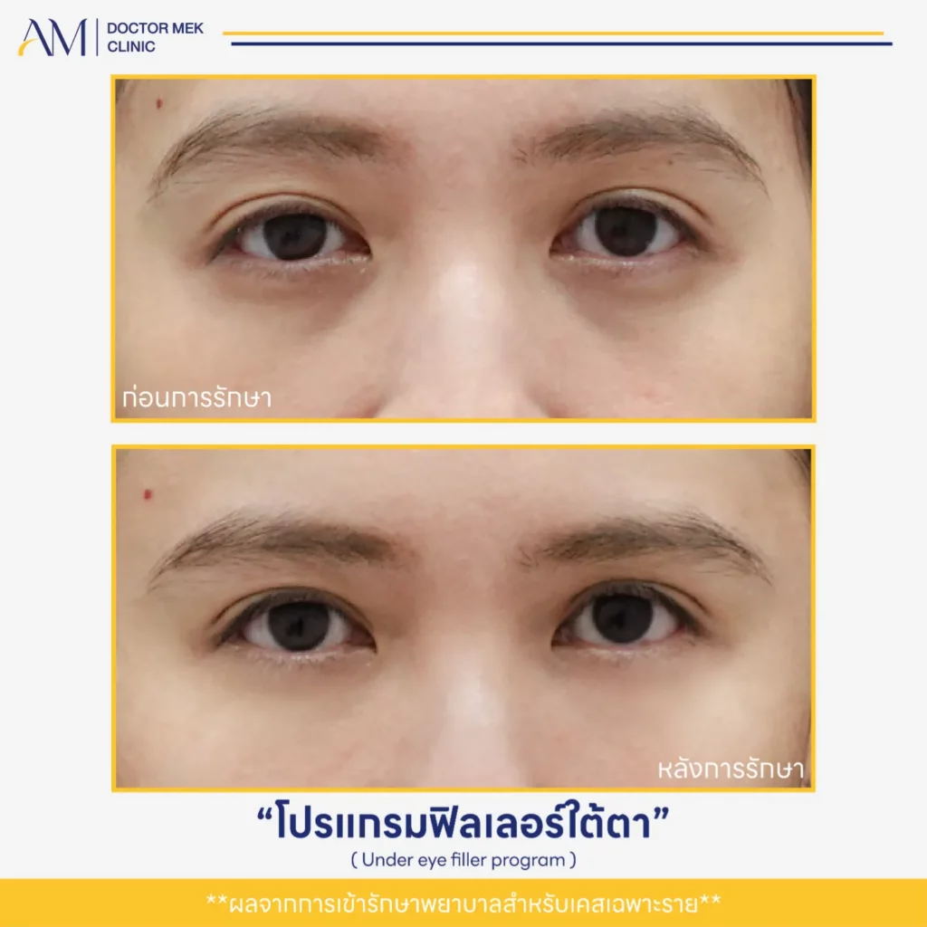 Before-After ฟิลเลอร์ใต้ตา-03