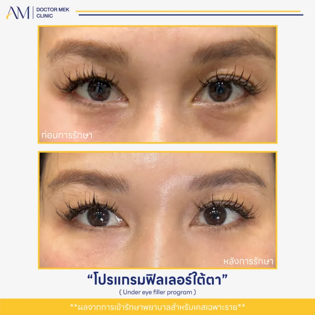 Before-After ฟิลเลอร์ใต้ตา-04