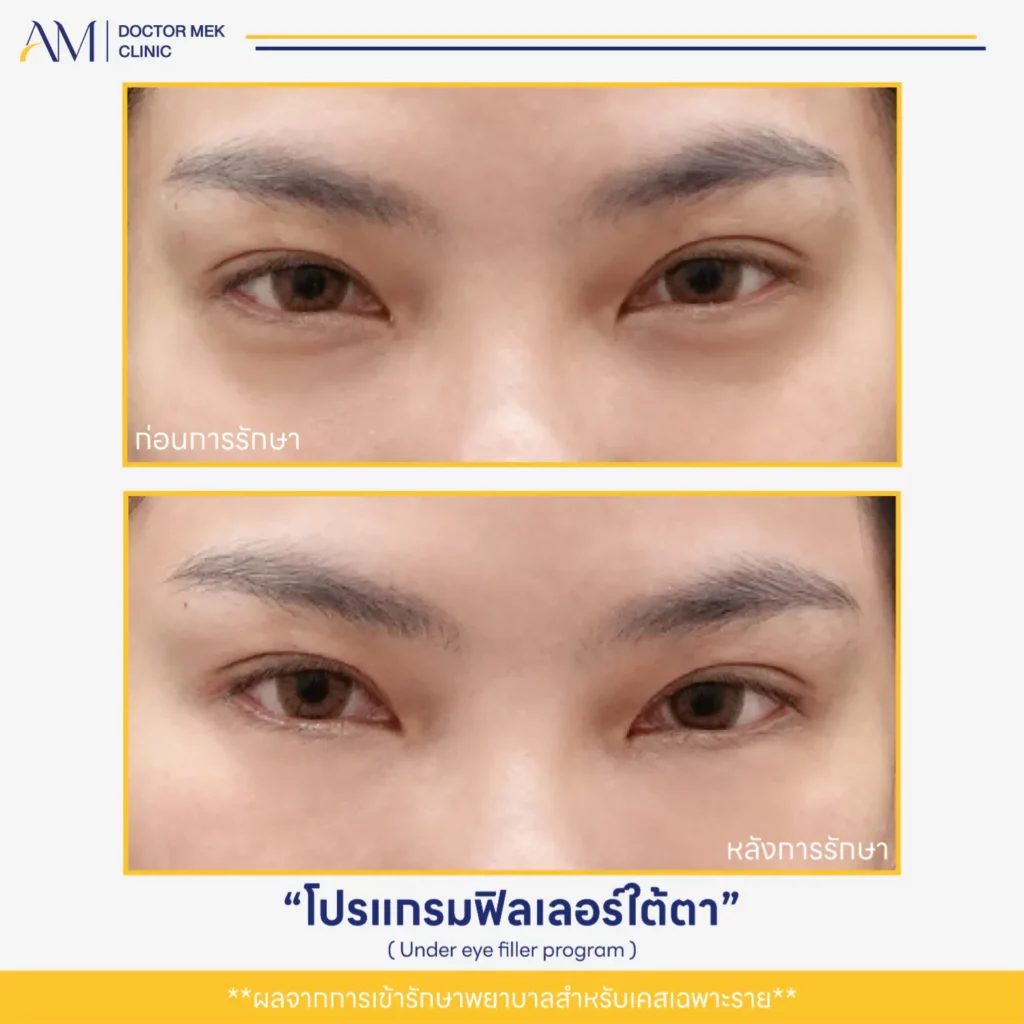 Before-After ฟิลเลอร์ใต้ตา-05