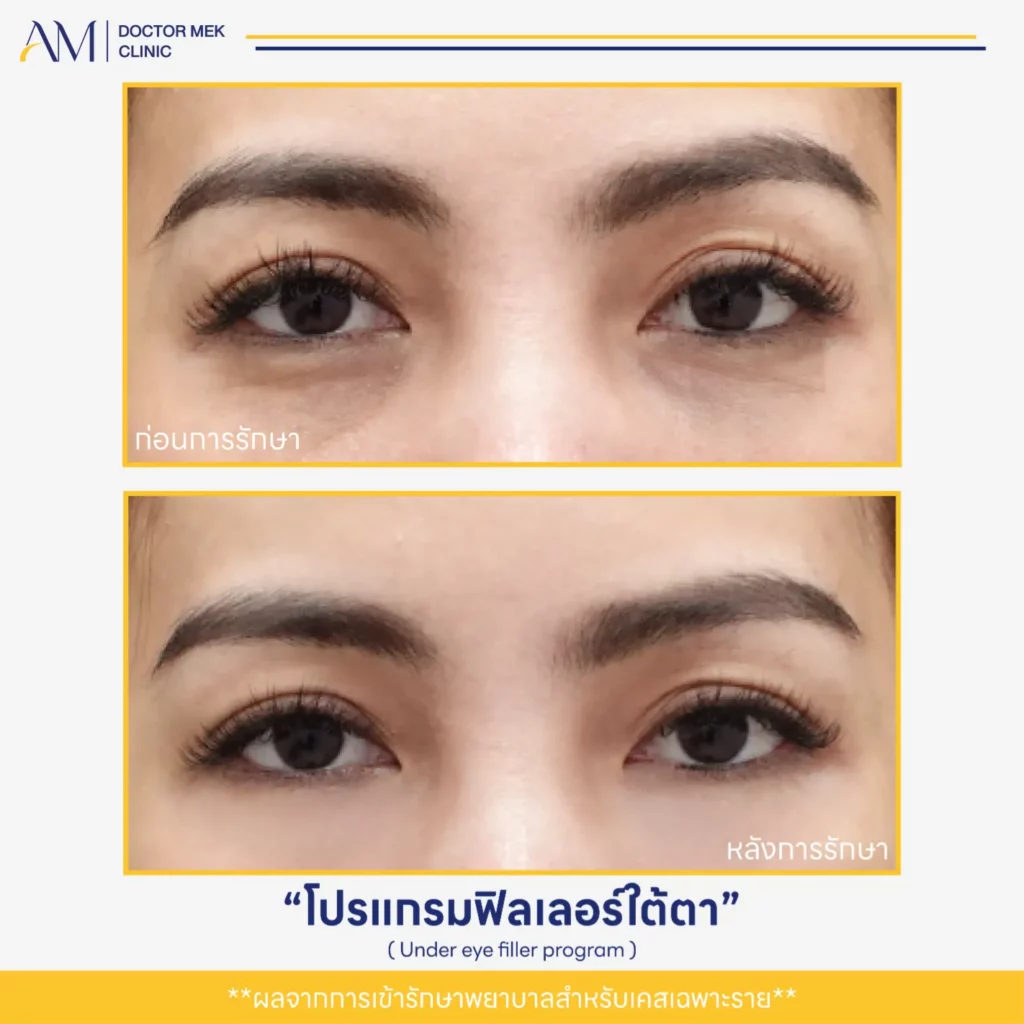 Before-After ฟิลเลอร์ใต้ตา-06