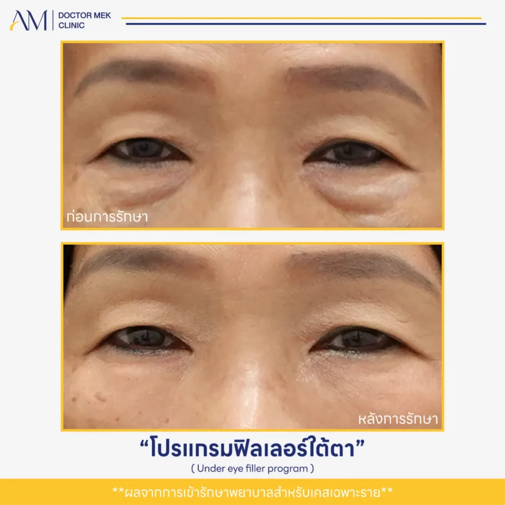 Before-After ฟิลเลอร์ใต้ตา-07