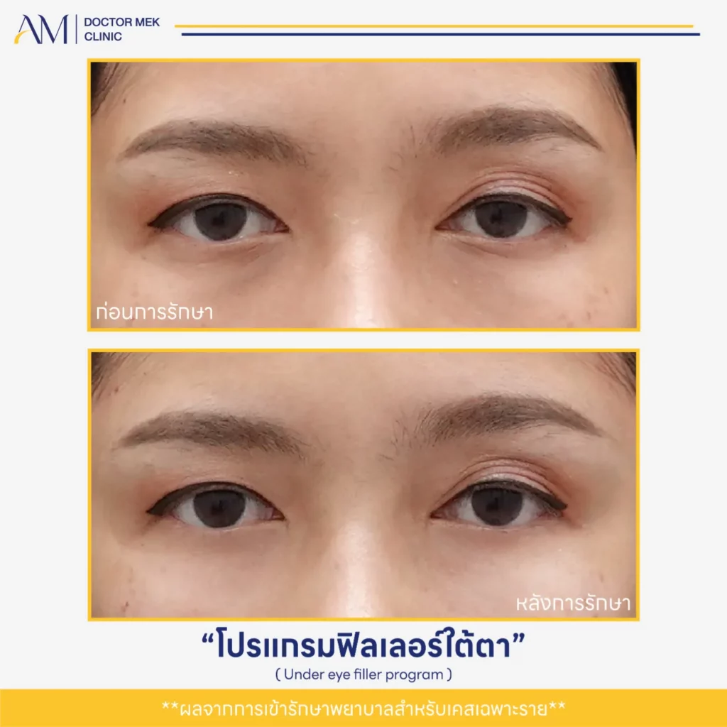 Before-After ฟิลเลอร์ใต้ตา-08