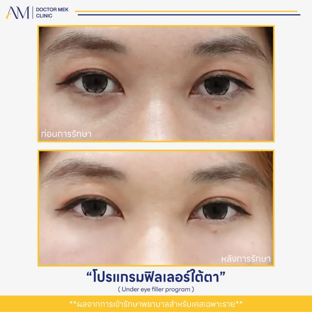 Before-After ฟิลเลอร์ใต้ตา-09