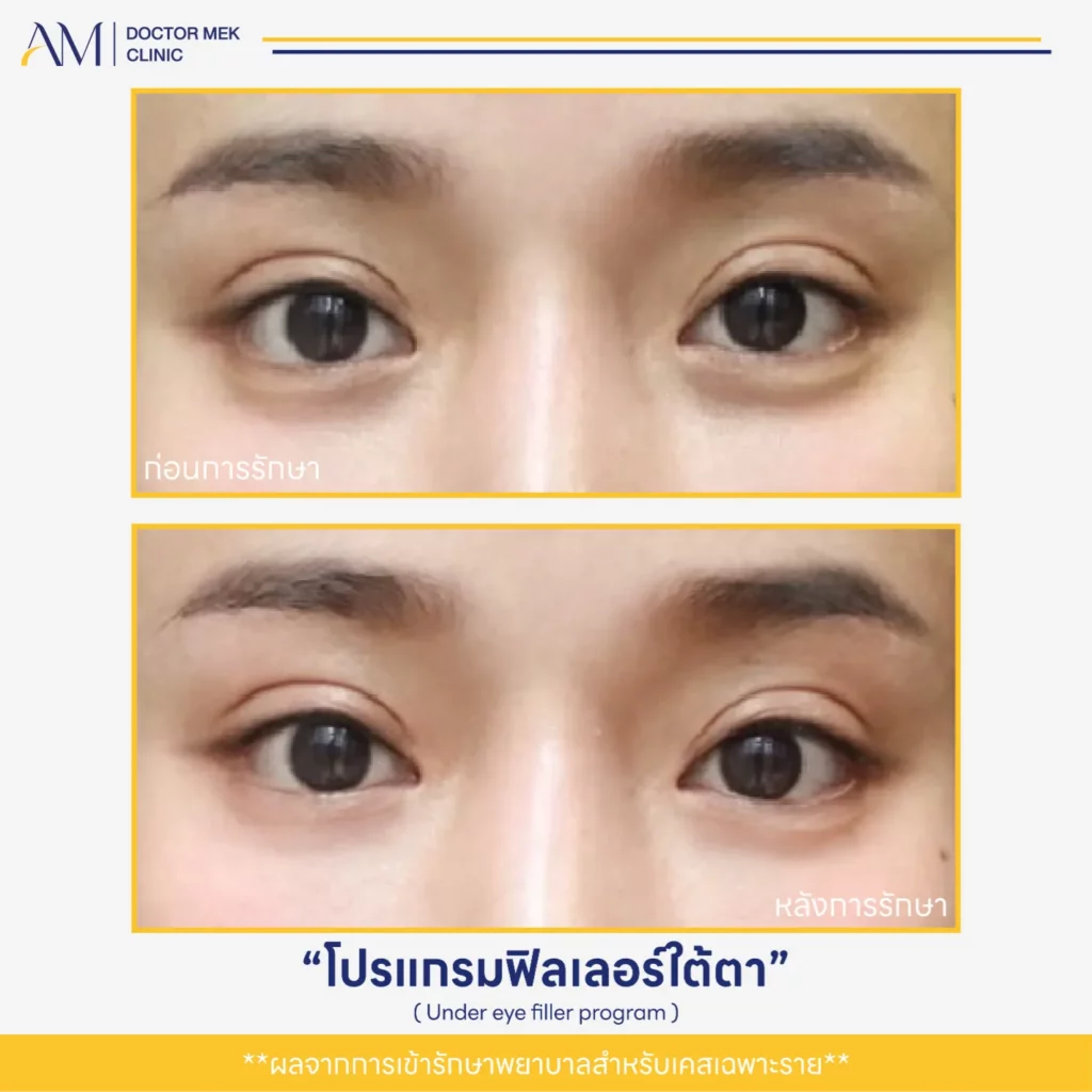 Before-After ฟิลเลอร์ใต้ตา-10