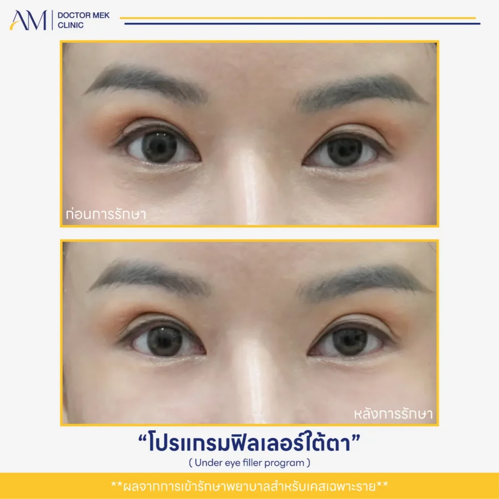 Before-After ฟิลเลอร์ใต้ตา-11