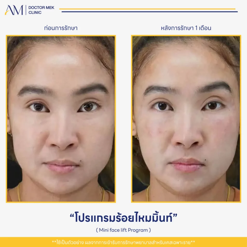 Before-After Mini Face Lift-01