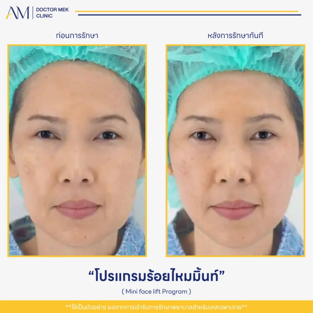 Before-After Mini Face Lift-02