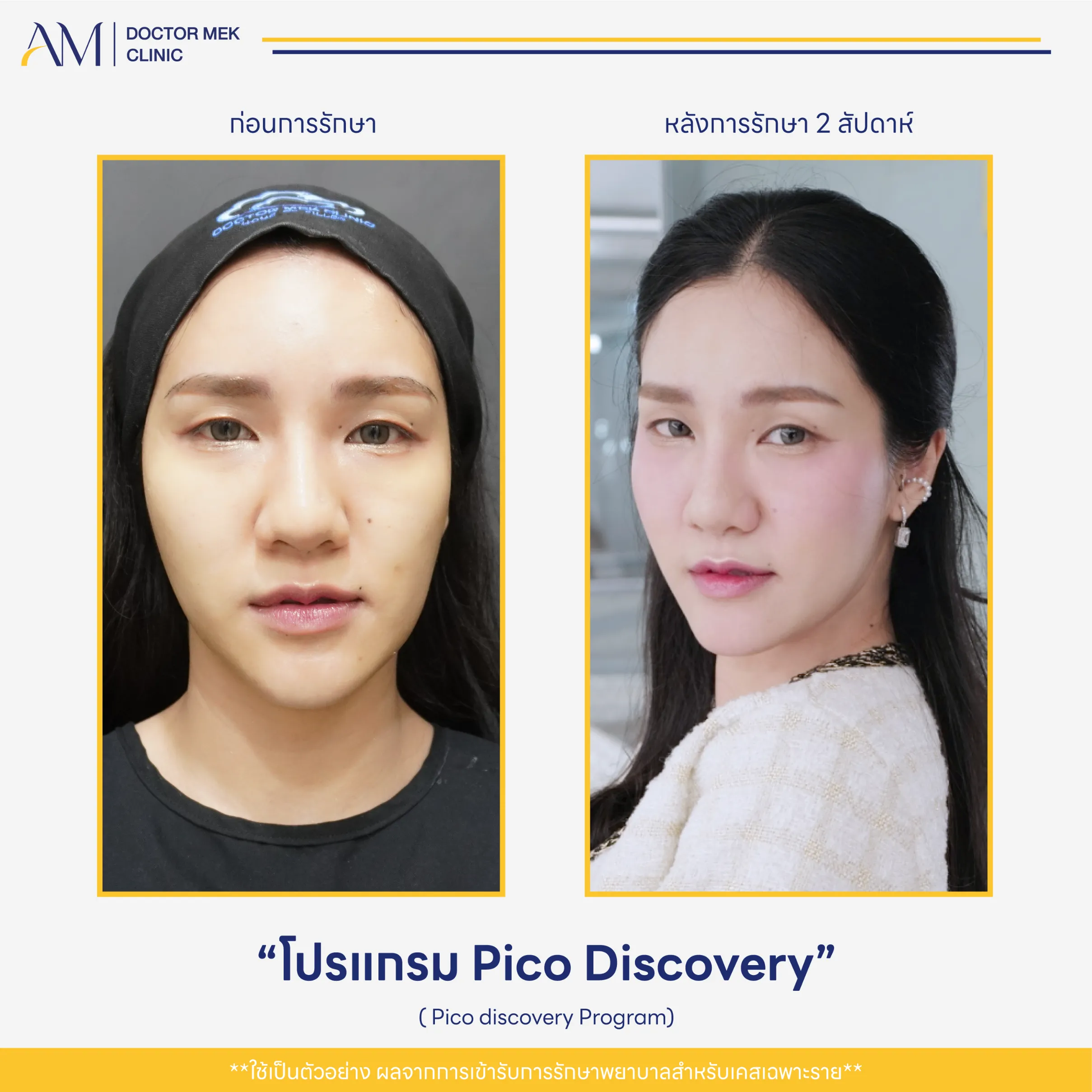 Before-After Pico Discovery-01