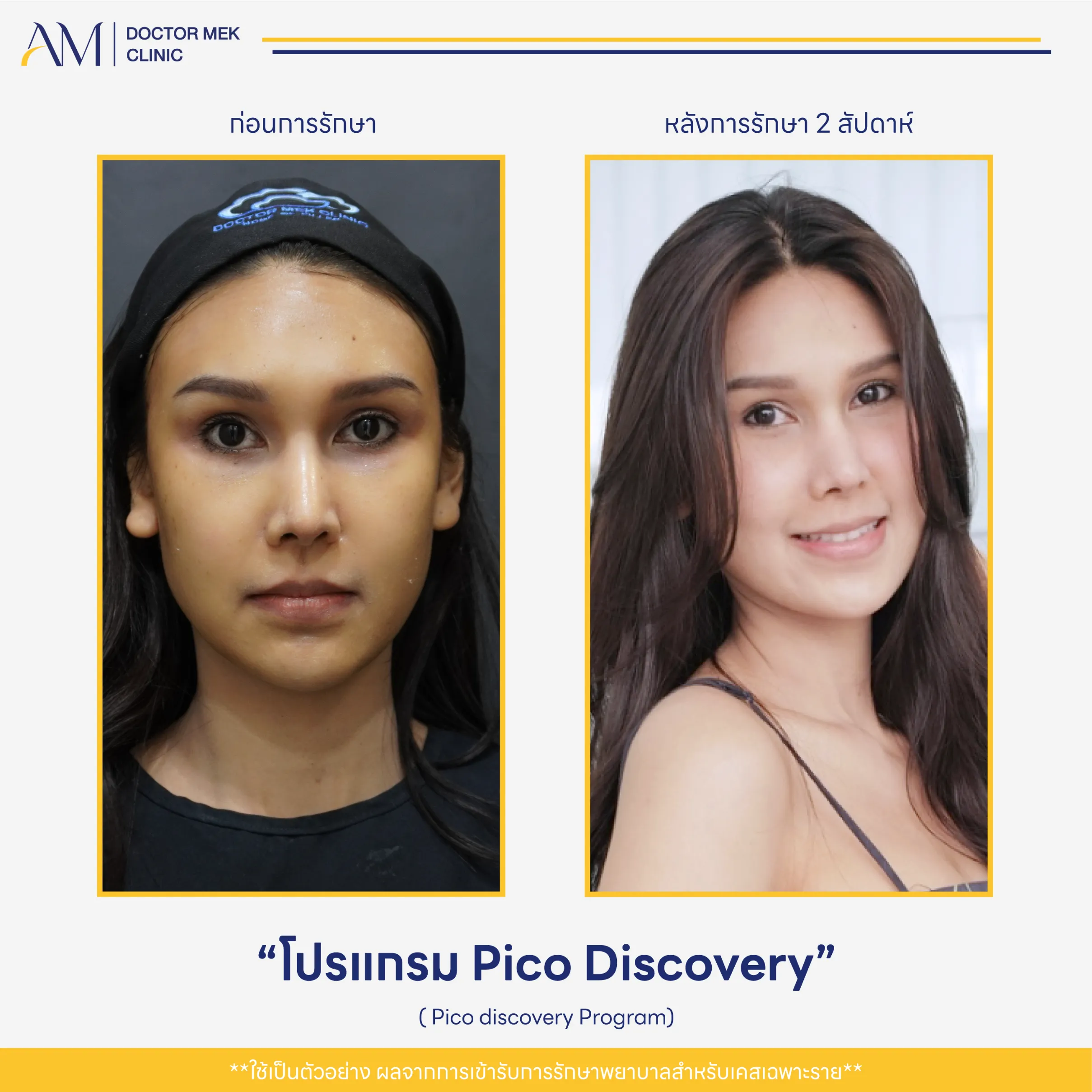 Before-After Pico Discovery-02