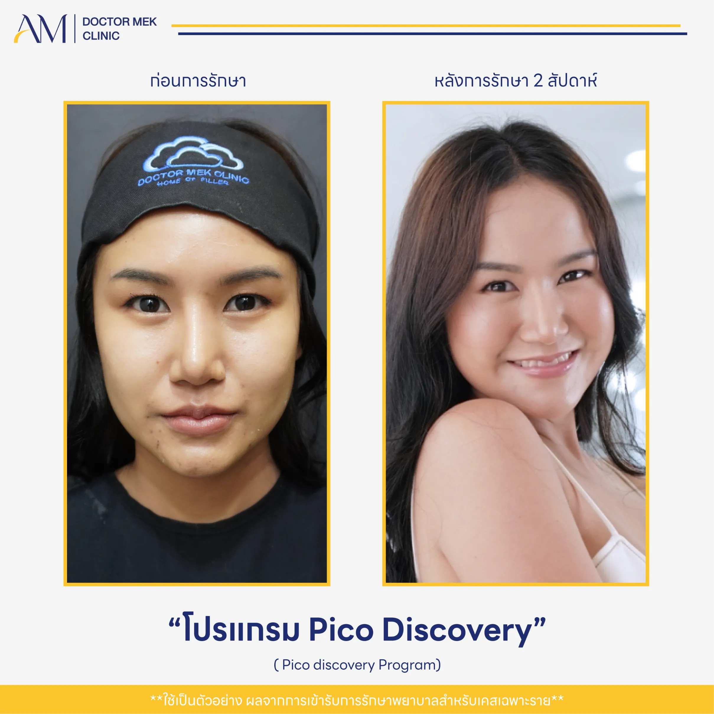 Before-After Pico Discovery-04