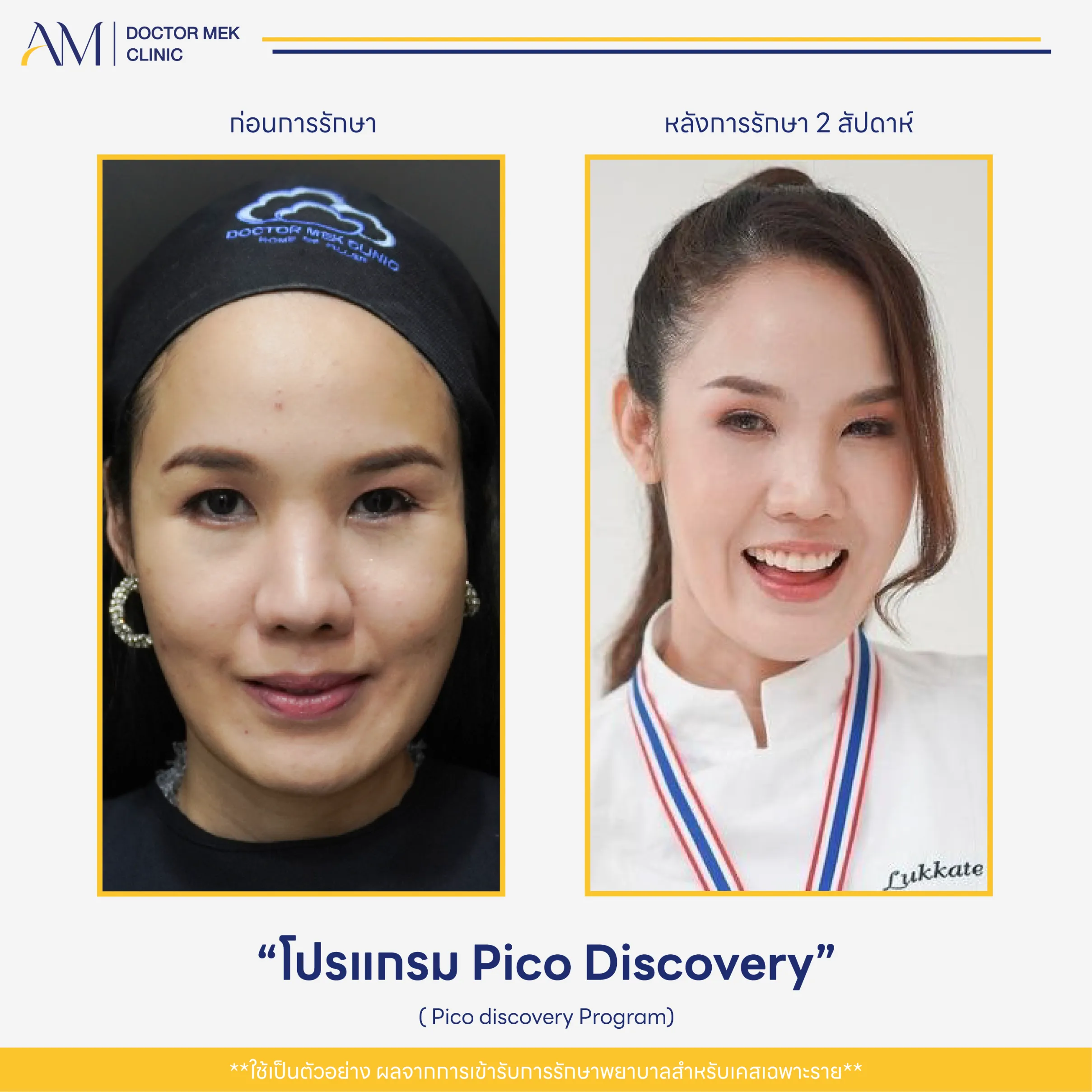 Before-After Pico Discovery-05