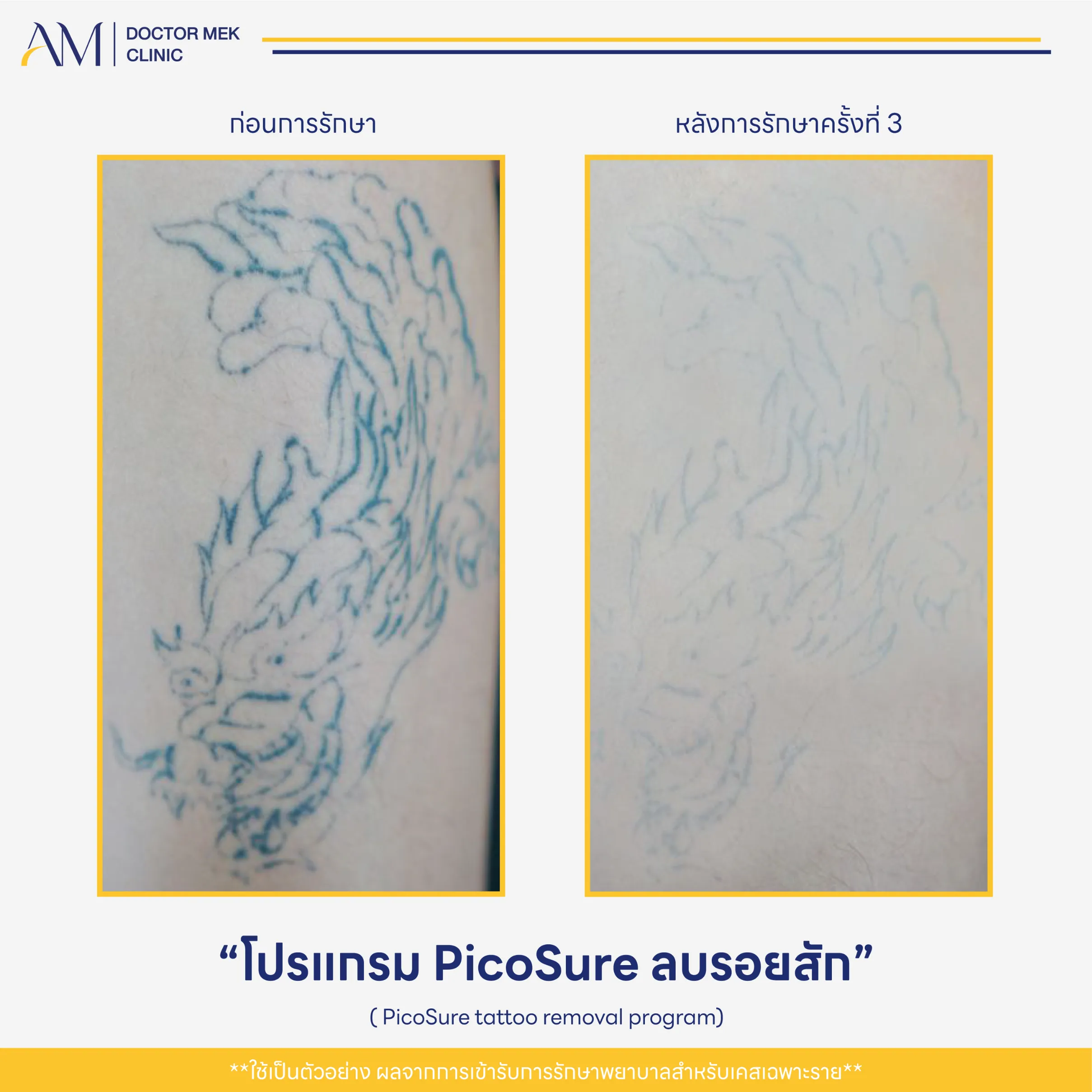 Before-After PicoSure Laser-01