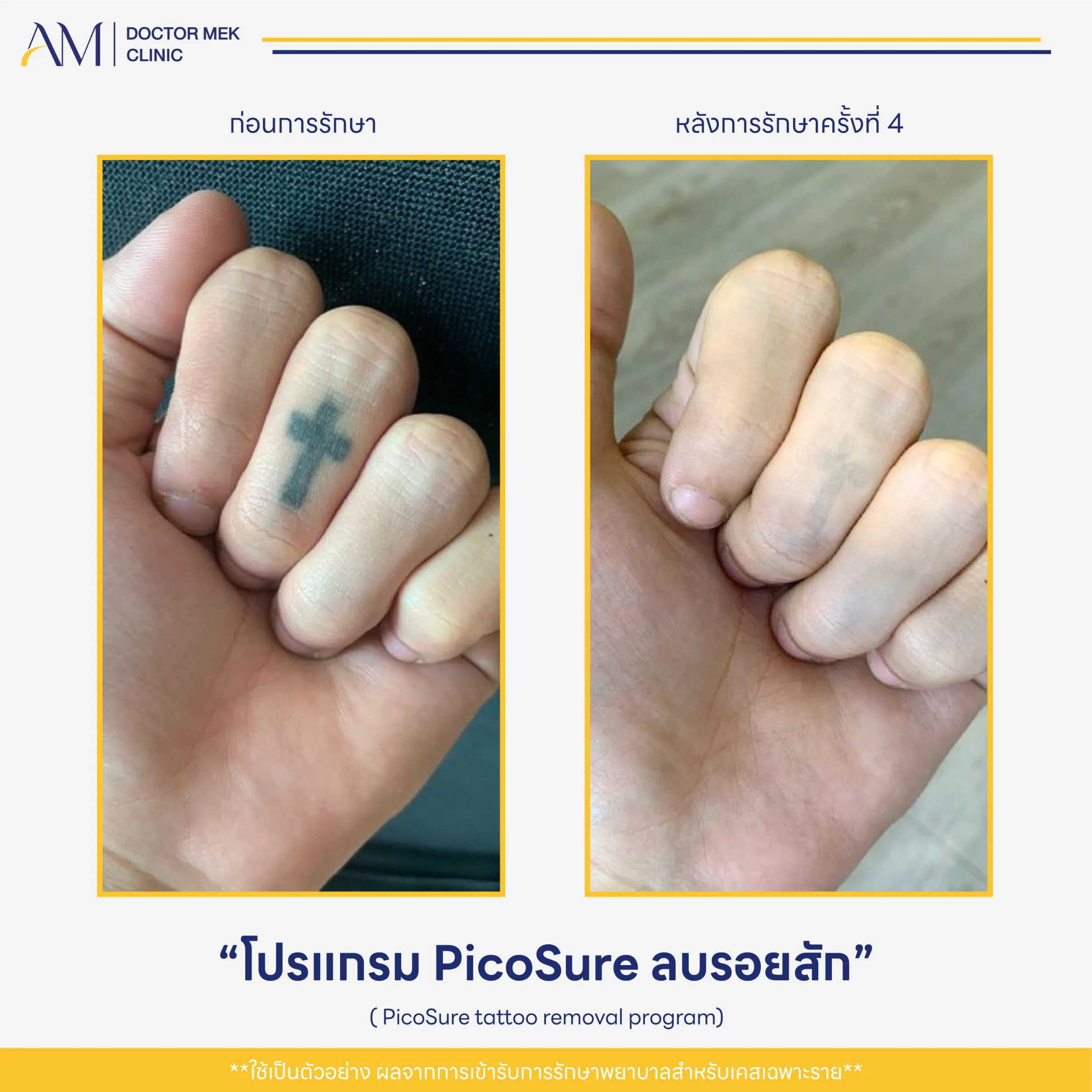 Before-After PicoSure Laser-02