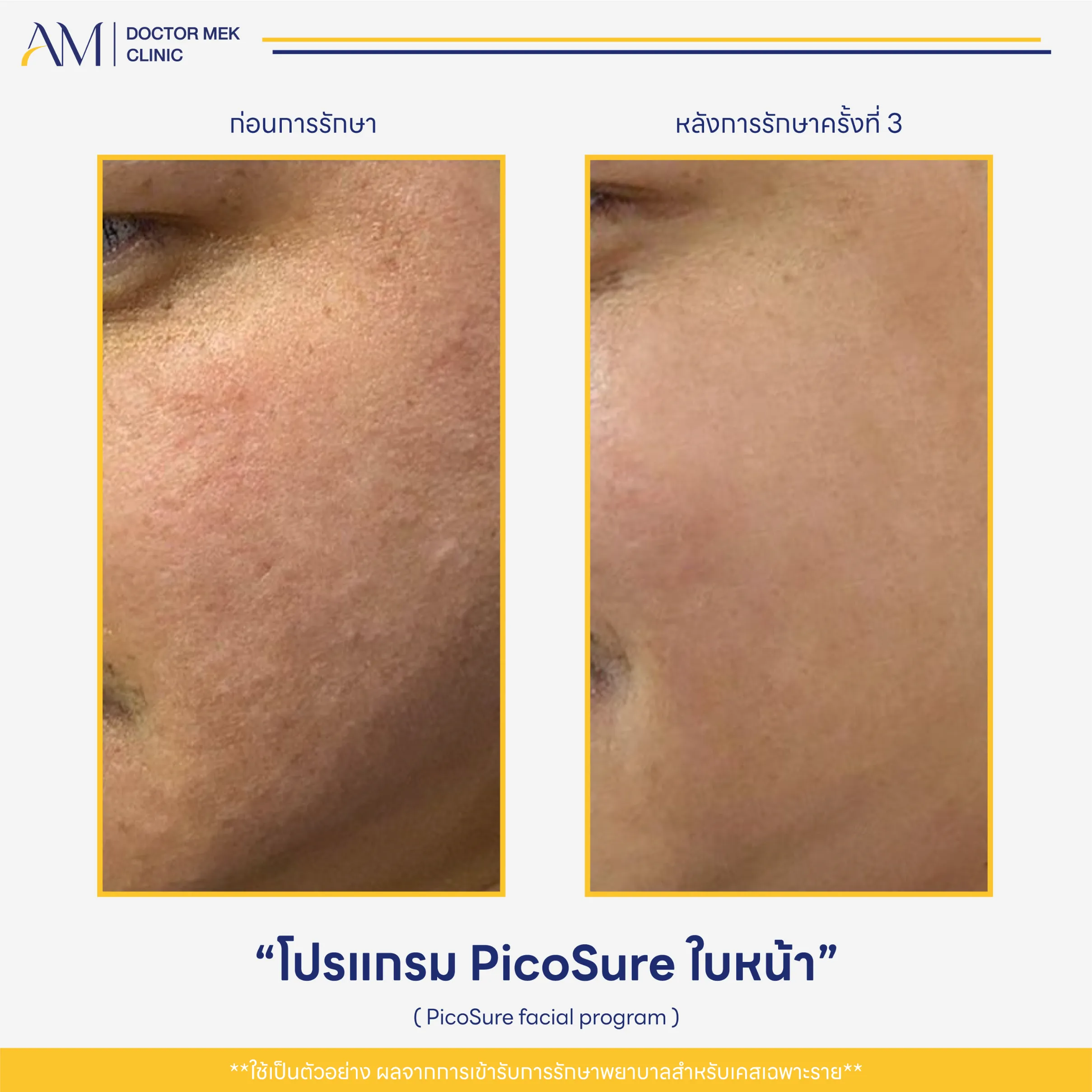 Before-After PicoSure Laser-03