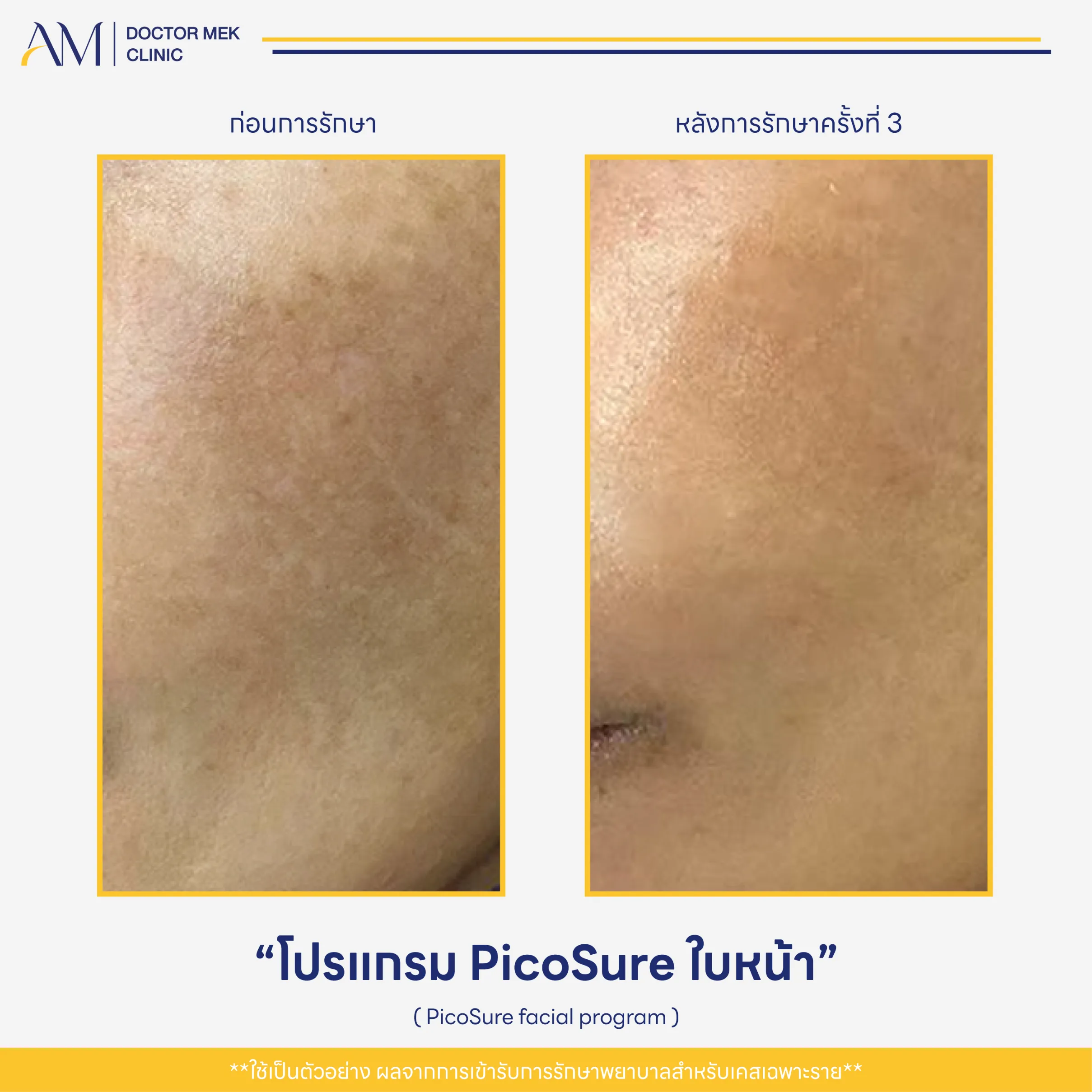 Before-After PicoSure Laser-04