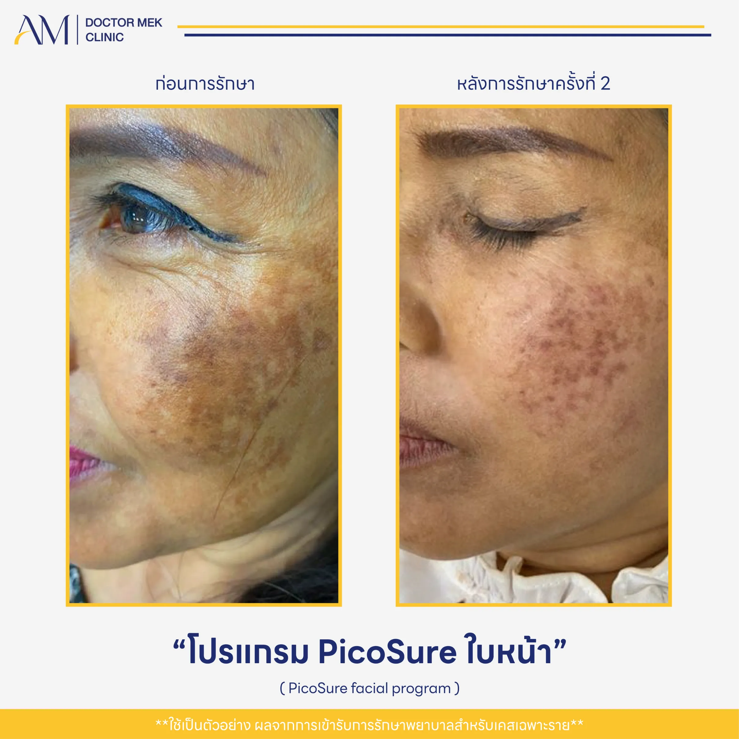Before-After PicoSure Laser-05