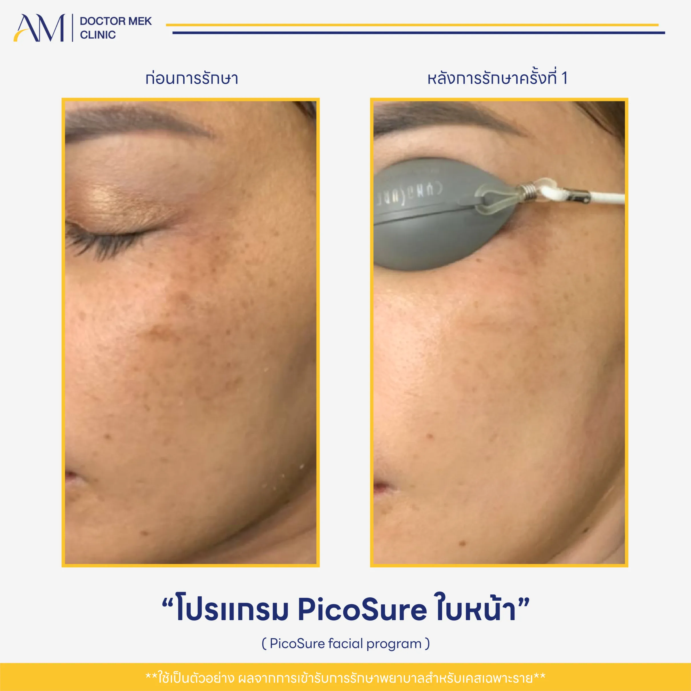Before-After PicoSure Laser-06