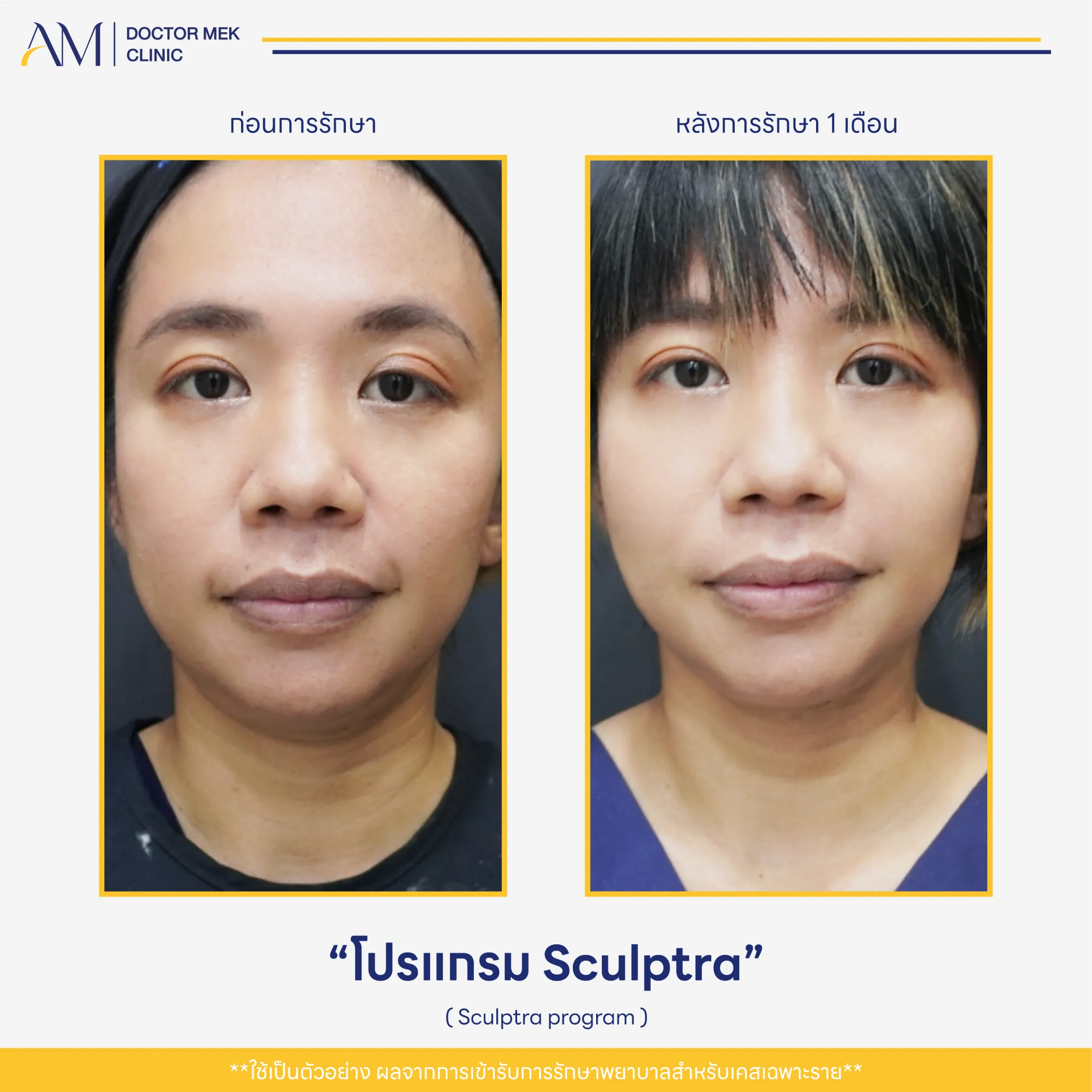 Before-After Sculptra-01