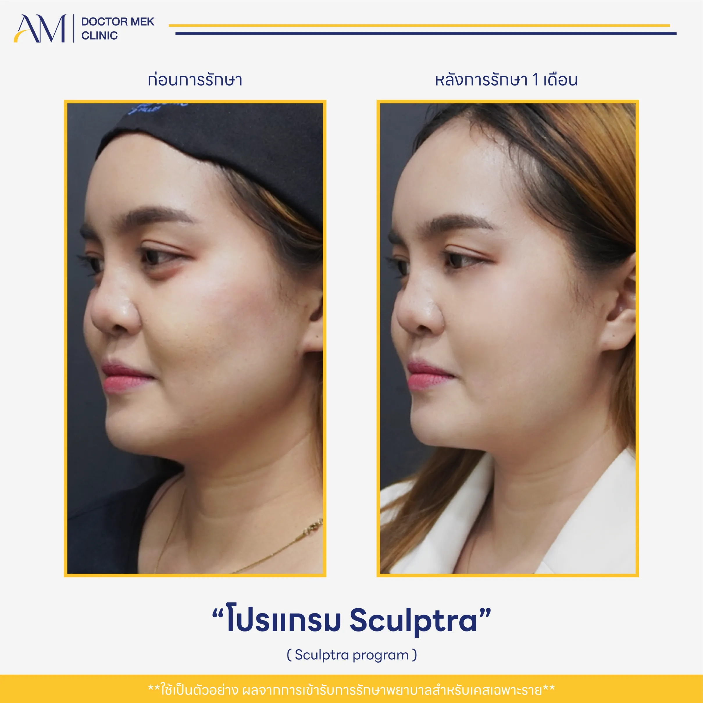 Before-After Sculptra-02