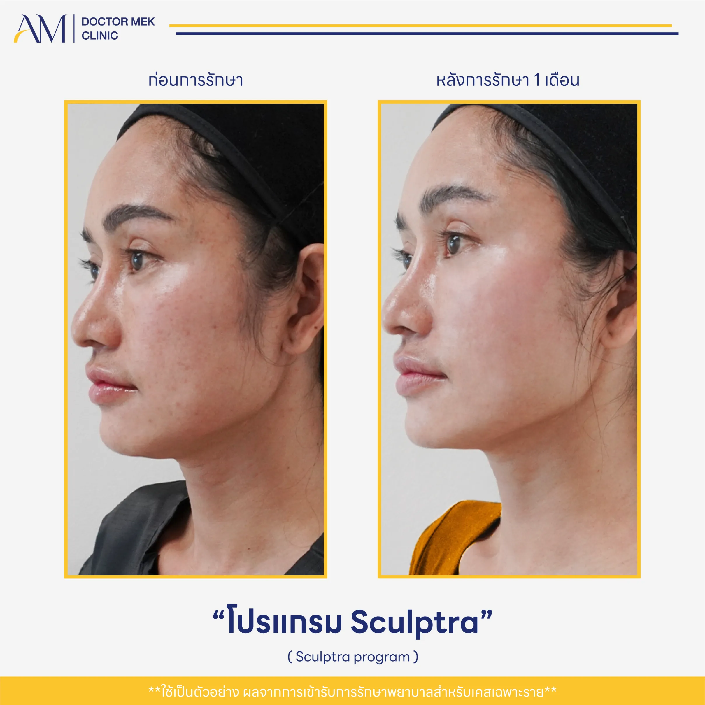Before-After Sculptra-03