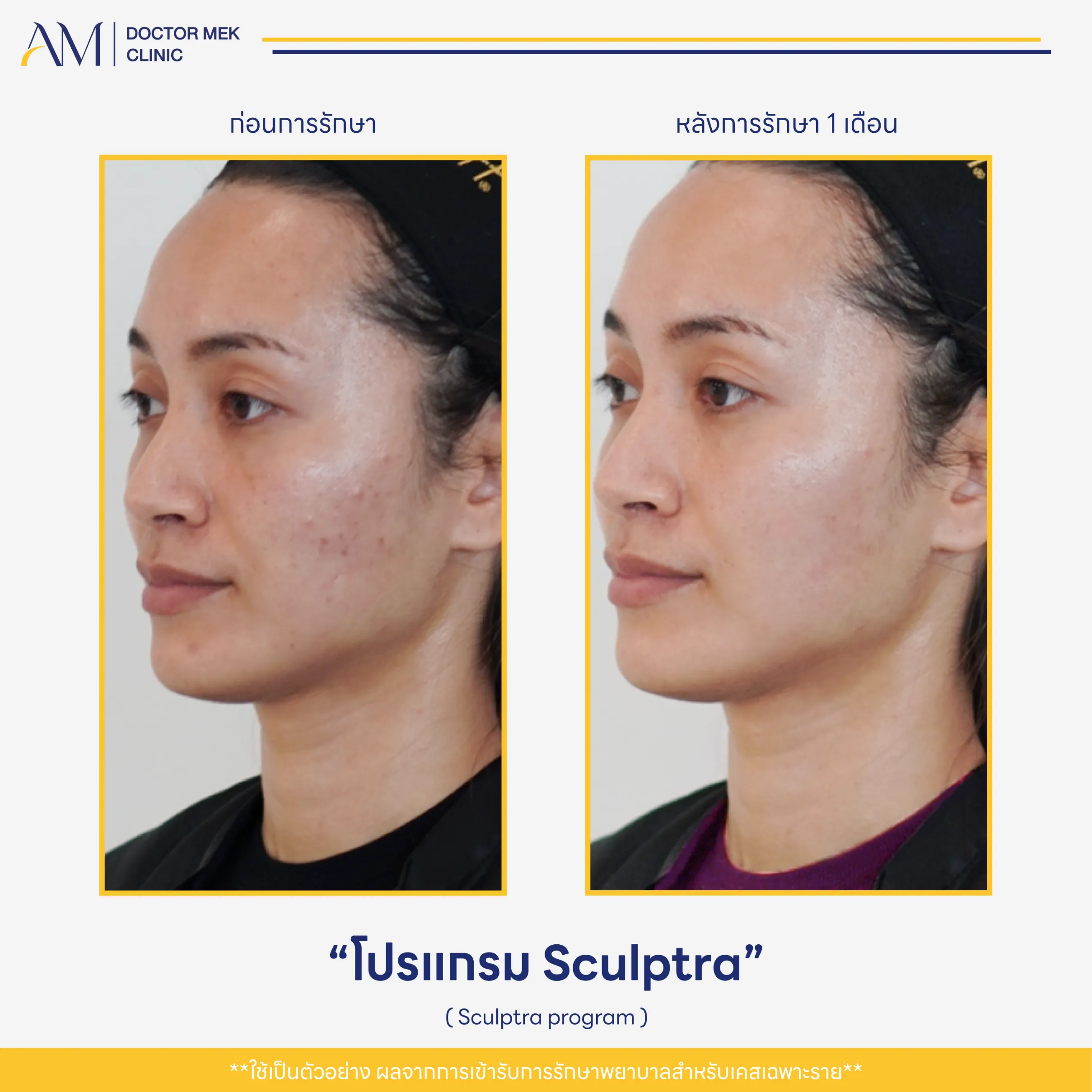 Before-After Sculptra-04