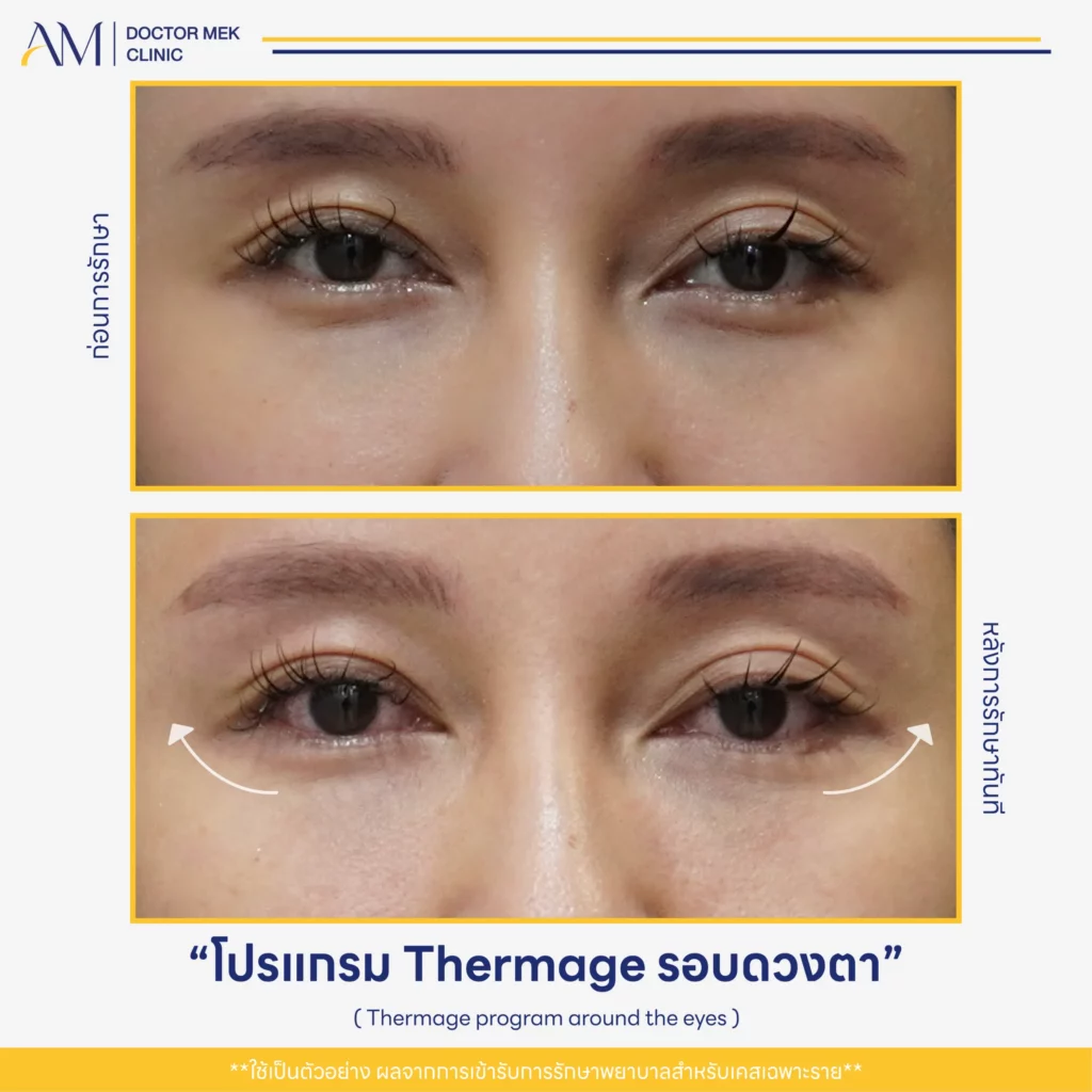 Before-After Thermage FLX ตา-01