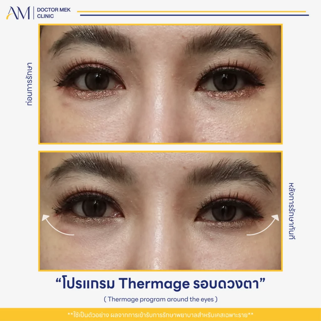 Before-After Thermage FLX ตา-02