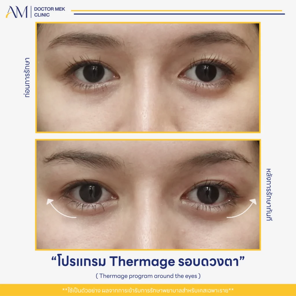Before-After Thermage FLX ตา-03