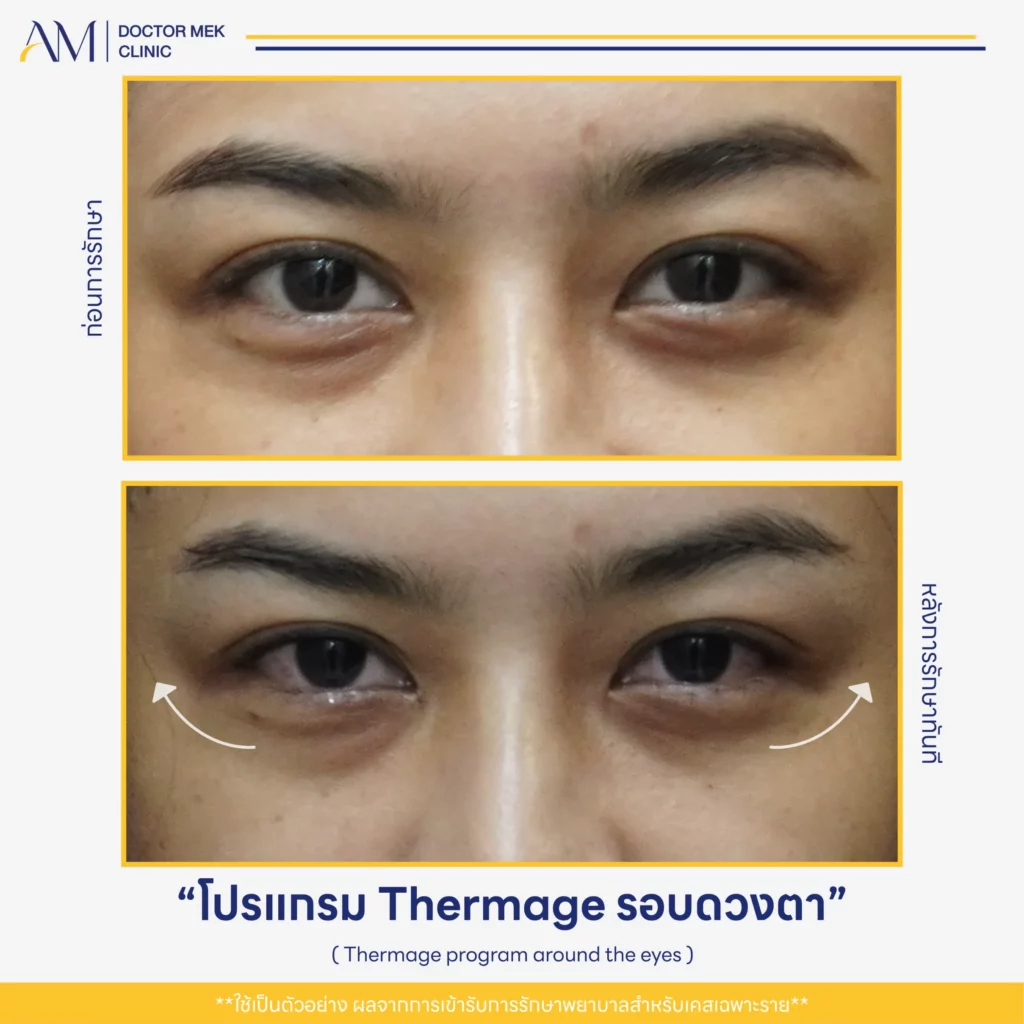 Before-After Thermage FLX ตา-04