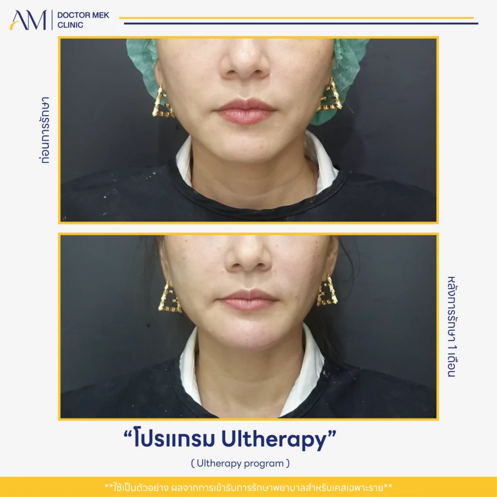 Before-After Ulthera-01