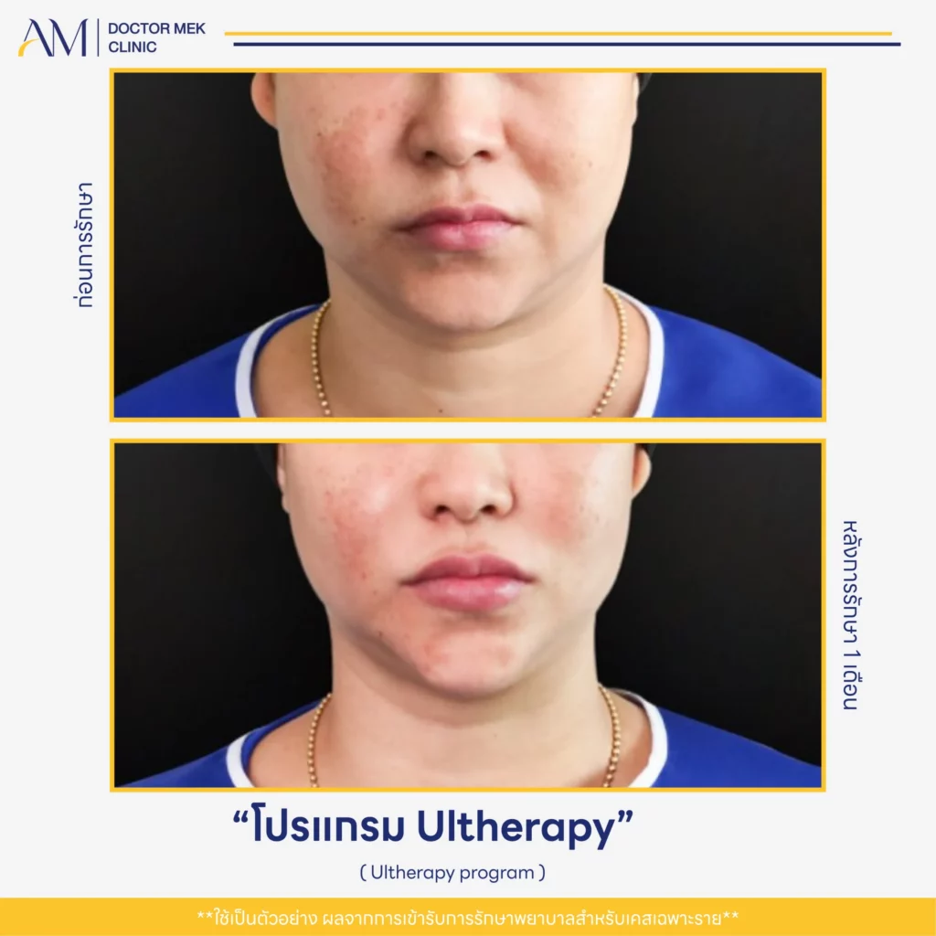Before-After Ulthera-02