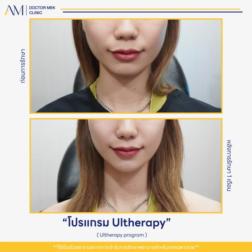 Before-After Ulthera-03