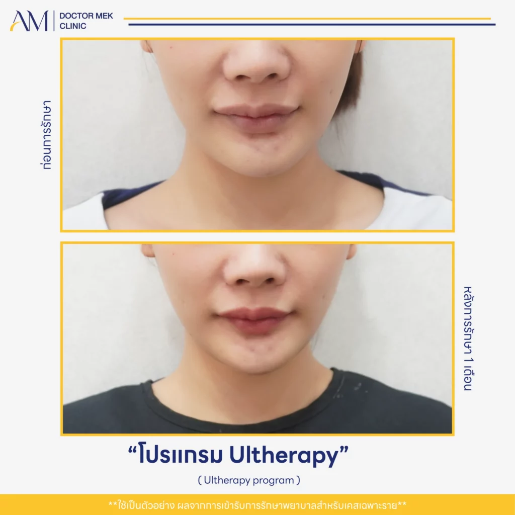 Before-After Ulthera-04